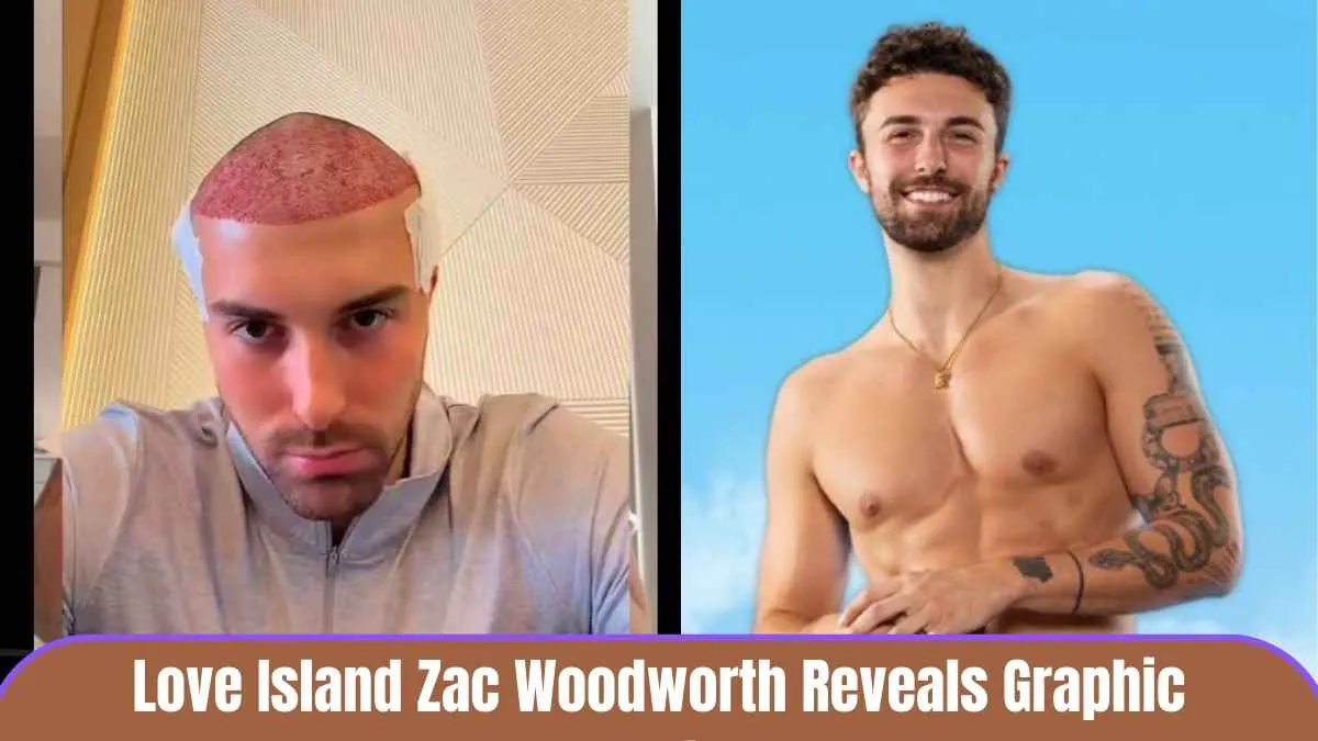 Love Island Zac Woodworth Reveals Graphic Details of Pre-Show Hair Transplant